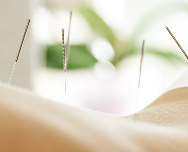 acupunctur