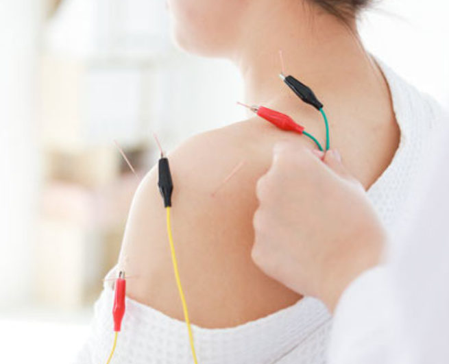 hand of doctor performing acupuncture therapy . Asian female undergoing acupuncture treatment with a line of fine needles inserted into the her body skin in clinic hospital